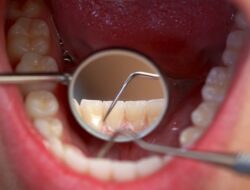 Cara Menghilangkan dan Mencegah Terjadinya Karang Gigi